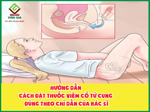 Phương pháp nào được áp dụng nhiều nhất để đặt thuốc viêm cổ tử cung?
