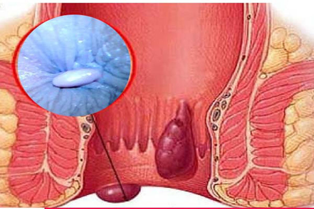 Bị mắc bệnh tắc mạch trĩ ngoại do đâu? Bị mắc bệnh tắc mạch trĩ ngoại do đâu?