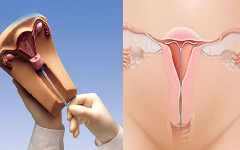 Bị viêm lộ tuyến cổ tử cung có đặt vòng được không?