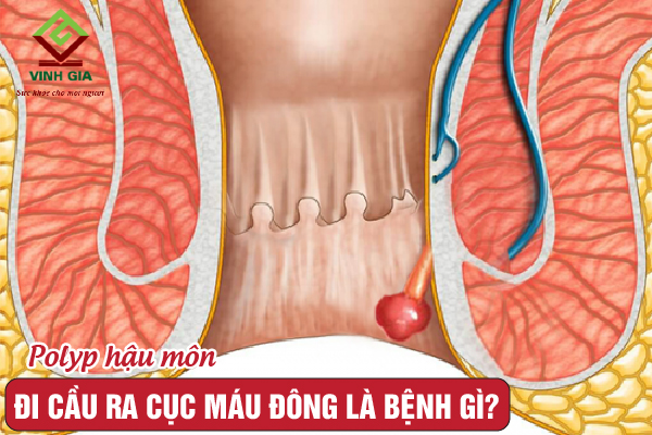 Đi ngoài ra máu đông có thể là do Polyp hậu môn