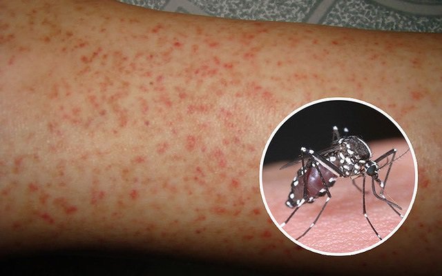 Sốt xuất huyết dengue có dấu hiệu cảnh báo gì?