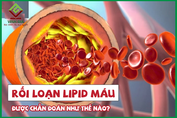 Cách định lượng lipid huyết thanh để chẩn đoán rối loạn lipid máu như thế nào?
