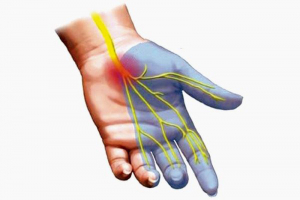 Hội chứng ống cổ tay là gì và đâu là những nguyên nhân gây nên tình trạng này?