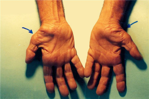Giải đáp thắc mắc: Mổ hội chứng ống cổ tay bao lâu lành?
