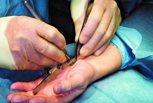 Nên tìm hiểu nhiều hơn về các phương pháp phẫu thuật hội chứng ống cổ tay
