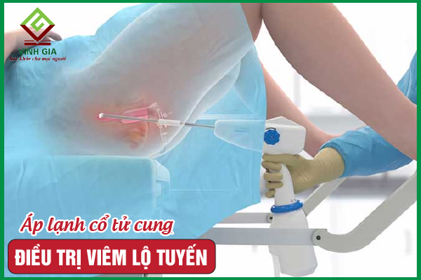 7. Những câu hỏi thường gặp về phun lạnh viêm lộ tuyến