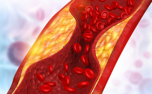 Điều trị tình trạng máu nhiễm mỡ bằng cách giảm cholesterol nhờ sử dụng thuốc