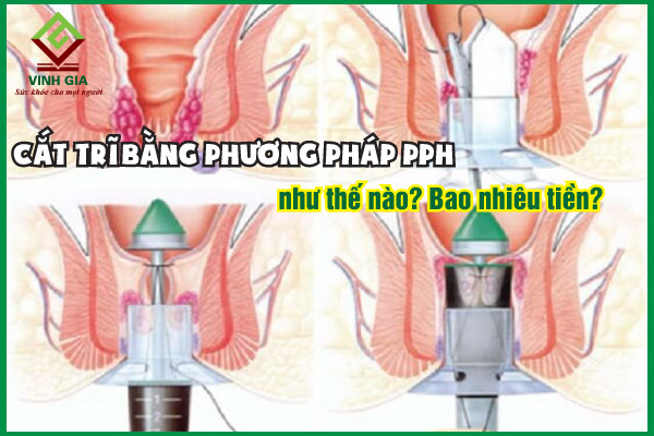 Có những loại trĩ nào có thể sử dụng phương pháp PPH?
