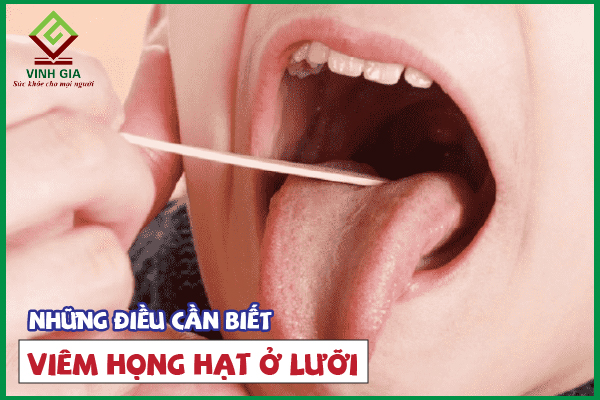 Viêm họng hạt ở lưỡi xảy ra do nguyên nhân gì?
