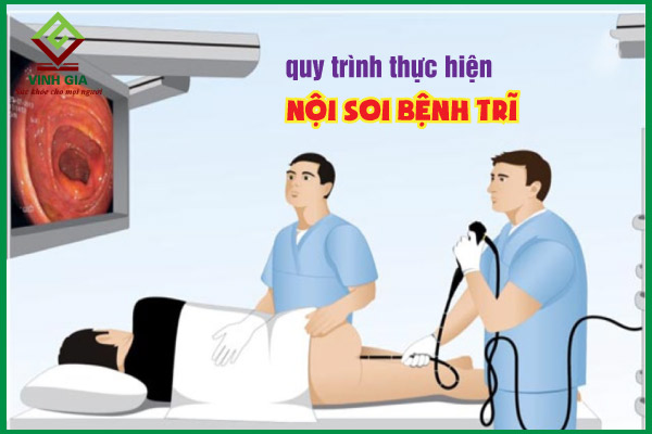 Nội soi trĩ là gì?
