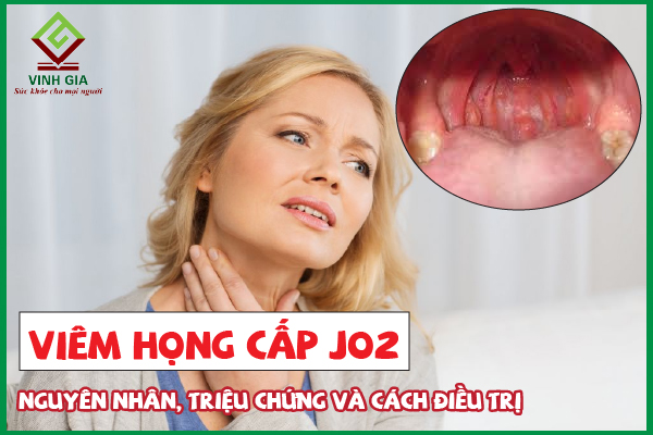 Tất cả về viêm họng cấp j02 giải đáp chi tiết