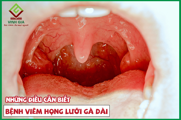 Viêm họng lưỡi gà dài có thể tự khỏi được không?