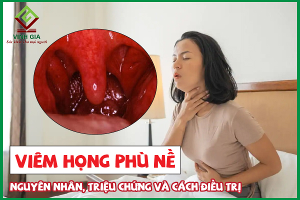 Chữa viêm họng phù nề hiệu quả với các phương pháp tự nhiên