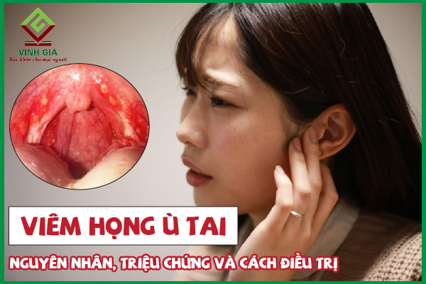 Những loại thực phẩm tốt cho  viêm họng gây ù tai 