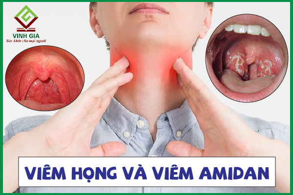 Triệu chứng và biểu hiện của viêm amidan và viêm họng là gì?
