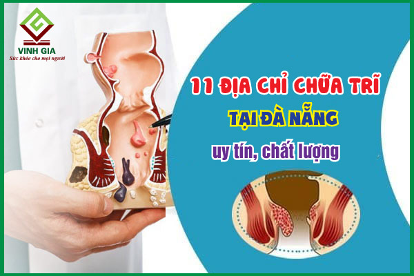 Top 11 địa chỉ chữa bệnh trĩ tại Đà Nẵng tốt nhất