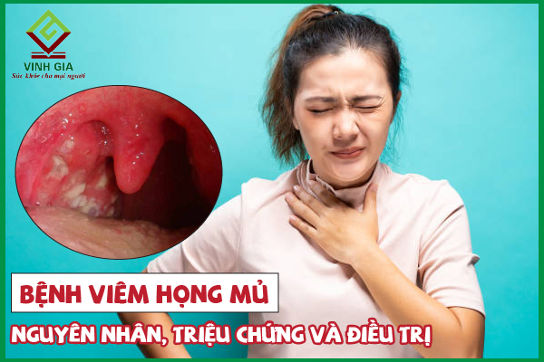 Các biện pháp phòng ngừa viêm họng có mủ ở người lớn là gì?
