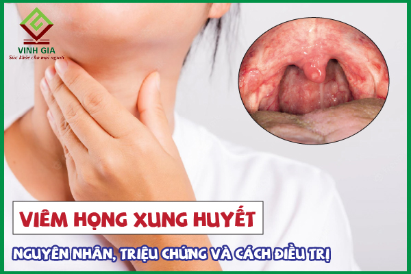 Viêm họng xung huyết có thể gây tổn thương nghiêm trọng không?
