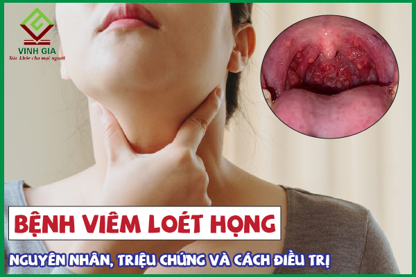 Có khả năng viêm họng loét gây biến chứng hoặc ảnh hưởng đến sức khỏe không?
