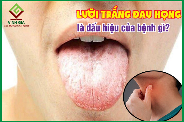 Lưỡi trắng đau họng là triệu chứng của bệnh gì?