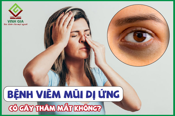 Viêm xoang là gì và tại sao nó có thể gây thâm mắt?
