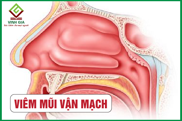 Có những biến chứng nào có thể xảy ra do viêm mũi vận mạch?
