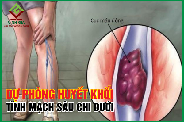 7 cách phòng ngừa huyết khối tĩnh mạch sâu